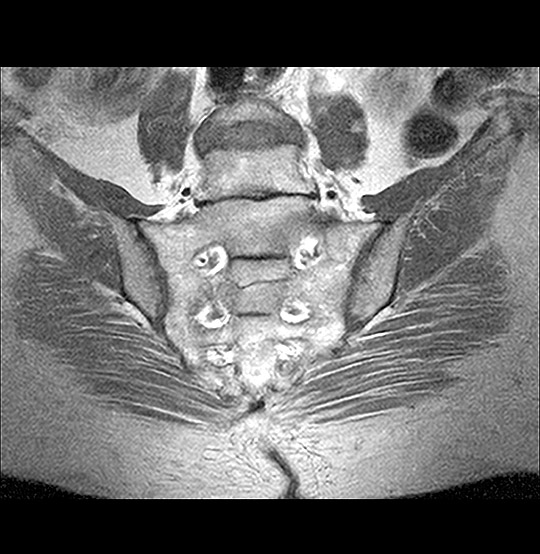 MRI Sacroiliac joint coronal view Scan (AI Enhanced)